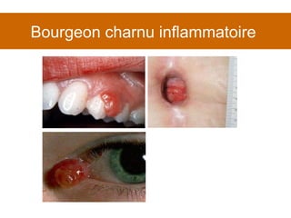 Bourgeon charnu inflammatoire  