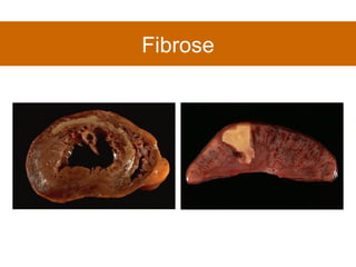 Fibrose 