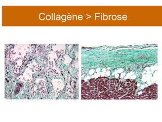 Collagène > Fibrose 
