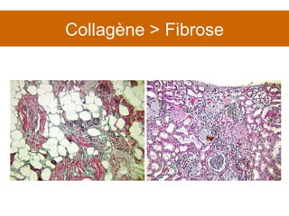 Collagène > Fibrose 
