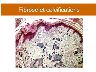 Fibrose et calcifications 