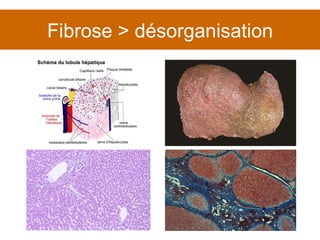 Fibrose > désorganisation 