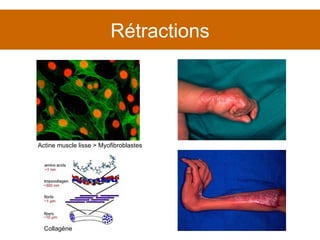 Rétractions Actine muscle lisse > Myofibroblastes Collagène 