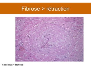 Fibrose > rétraction Vaisseaux > sténose 