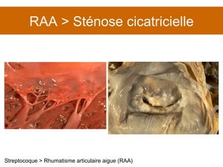 RAA > Sténose cicatricielle Streptocoque > Rhumatisme articulaire aigue (RAA) 