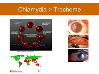 Chlamydia > Trachome 