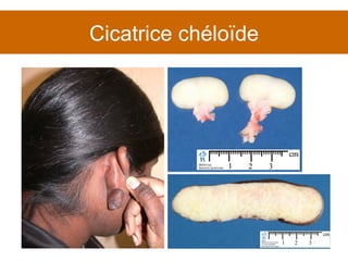 Cicatrice chéloïde 