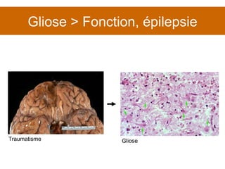 Gliose > Fonction, épilepsie Traumatisme Gliose 
