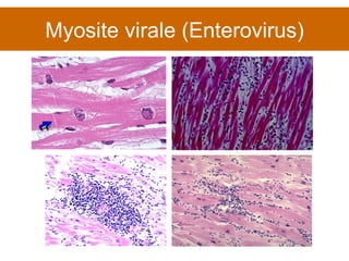 Myosite virale (Enterovirus) 