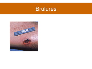 Brulures 