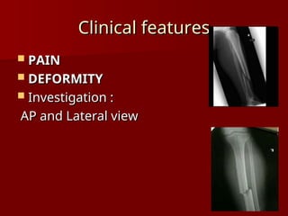 fracture_of_tibia_and_fibula modalities.ppt | Death, Injury, or ...