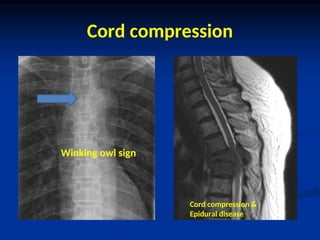 Bone Secondaries.ppt treatment ana various | PPT