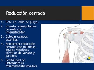Reducción cerrada
1. Pcte en «silla de playa»
2. Intentar manipulación
cerrada con
intensificador
3. Colocar campos
estériles
4. Reintentar reducción
cerrada con palancas,
agujas Kirschner,
tornillos de Schanz y
ganchos
5. Posibilidad de
Osteosíntesis
mínimamente invasiva
 
