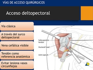 Acceso deltopectoral
Vía clásica
A través del surco
deltopectoral
Vena cefálica visible
Tendón como
referencia anatómica
Evitar lesiona vasos
circunflejos
VÍAS DE ACCESO QUIRÚRGICOS
 