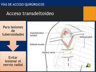 Acceso transdeltoideo
VÍAS DE ACCESO QUIRÚRGICOS
Evitar
lesionar el
nervio radial
Para lesiones
de
tuberosidades
 