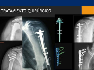TRATAMIENTO QUIRÚRGICO
 