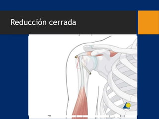 Reducción cerrada
 