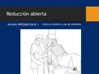 Reducción abierta
Acceso deltopectoral + Sutura a tensión o uso de alambres
 