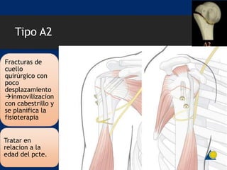 Tipo A2
Fracturas de
cuello
quirúrgico con
poco
desplazamiento
inmovilizacion
con cabestrillo y
se planifica la
fisioterapia
Tratar en
relacion a la
edad del pcte.
 