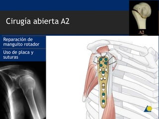 Cirugía abierta A2
Reparación de
manguito rotador
Uso de placa y
suturas
 