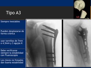 Tipo A3
Siempre inestables
Pueden desplazarse de
forma crónica
usar tornillos de 7mm
o 4,5mm y 3 agujas K
Debe verificarse
siempre la estabilidad
con Fluoroscopio
Los clavos no fresados
dan buena estabilidad
 