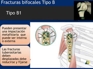Tipo B1
Pueden presentar
una impactación
metafisiaria que
puede ser interna
o externa
Las fracturas
tuberositarias
deben
desplazadas debe
reducirse y fijarse
Fracturas bifocales Tipo B
 