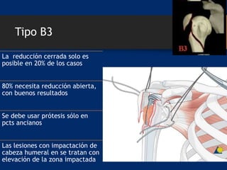 Tipo B3
La reducción cerrada solo es
posible en 20% de los casos
80% necesita reducción abierta,
con buenos resultados
Se debe usar prótesis sólo en
pcts ancianos
Las lesiones con impactación de
cabeza humeral en se tratan con
elevación de la zona impactada
 
