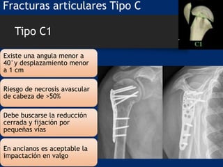 Tipo C1
Existe una angula menor a
40°y desplazamiento menor
a 1 cm
Riesgo de necrosis avascular
de cabeza de >50%
Debe buscarse la reducción
cerrada y fijación por
pequeñas vías
En ancianos es aceptable la
impactación en valgo
Fracturas articulares Tipo C
 
