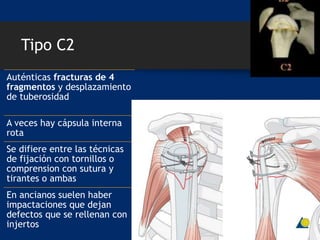 Tipo C2
Auténticas fracturas de 4
fragmentos y desplazamiento
de tuberosidad
A veces hay cápsula interna
rota
Se difiere entre las técnicas
de fijación con tornillos o
comprension con sutura y
tirantes o ambas
En ancianos suelen haber
impactaciones que dejan
defectos que se rellenan con
injertos
 