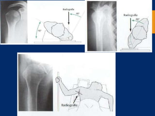 Fracturas de humero proximal AO