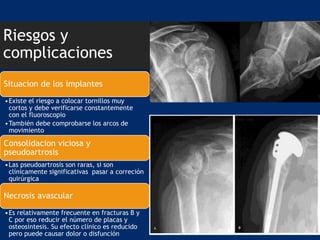 Riesgos y
complicaciones
Situacion de los implantes
•Existe el riesgo a colocar tornillos muy
cortos y debe verificarse constantemente
con el fluoroscopio
•También debe comprobarse los arcos de
movimiento
Consolidacion viciosa y
pseudoartrosis
•Las pseudoartrosis son raras, si son
clínicamente significativas pasar a correción
quirúrgica
Necrosis avascular
•Es relativamente frecuente en fracturas B y
C por eso reducir el número de placas y
osteosíntesis. Su efecto clínico es reducido
pero puede causar dolor o disfunción
 