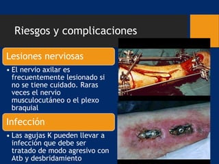 Riesgos y complicaciones
Lesiones nerviosas
• El nervio axilar es
frecuentemente lesionado si
no se tiene cuidado. Raras
veces el nervio
musculocutáneo o el plexo
braquial
Infección
• Las agujas K pueden llevar a
infección que debe ser
tratado de modo agresivo con
Atb y desbridamiento
 