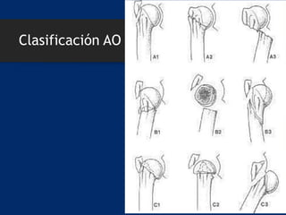 Clasificación AO
 