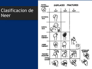 Clasificacion de
Neer
 