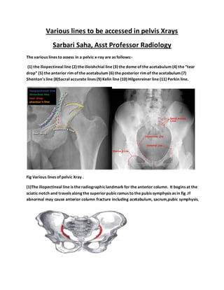 Various lines to be accessed in pelvis Xrays
Sarbari Saha, Asst Professor Radiology
The various lines to assess in a pelvic x-ray are as follows:-
(1) the iliopectineal line (2) the ilioishchial line (3) the dome of the acetabulum (4) the “tear
drop” (5) the anterior rim of the acetabulum (6) the posterior rim of the acetabulum (7)
Shenton's line (8)Sacral accurate lines (9) Kelin line (10) Hilgenreiner line (11) Perkin line.
Fig Various lines of pelvic Xray .
(1)The iliopectineal line is the radiographiclandmark for the anterior column. It begins at the
sciatic notch and travels along the superiorpubicramus to the pubis symphysis as in fig .If
abnormal may cause anterior column fracture including acetabulum, sacrum,pubic symphysis.
 
