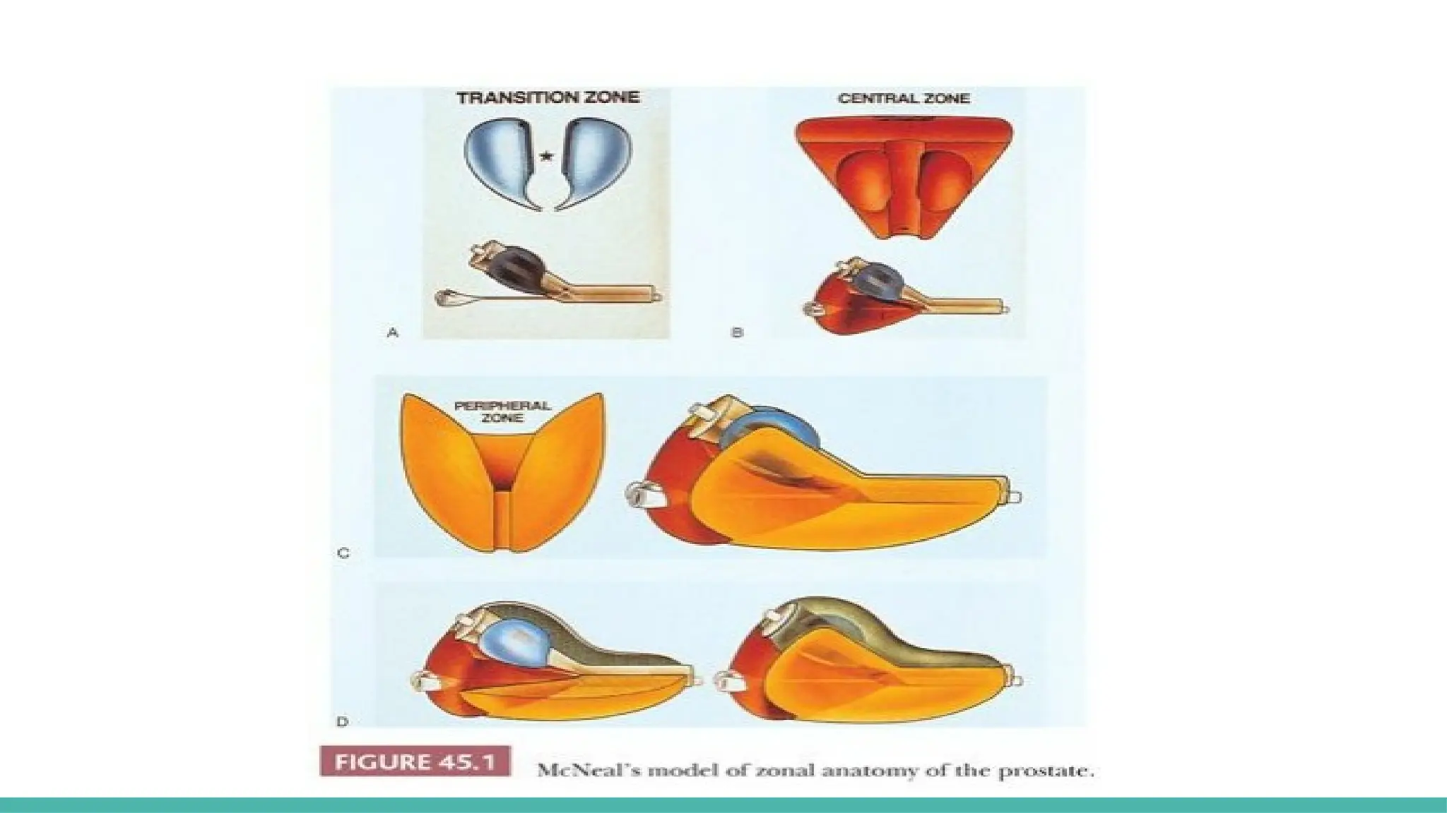 Prostate Pattern D MORPHOLOGICAL PATTERNS OF PROSTATE TUMORS.pptx