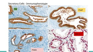 Prostate Pattern D MORPHOLOGICAL PATTERNS OF PROSTATE TUMORS.pptx