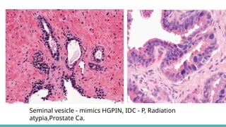 Prostate Pattern D MORPHOLOGICAL PATTERNS OF PROSTATE TUMORS.pptx