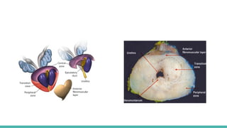 Prostate Pattern D MORPHOLOGICAL PATTERNS OF PROSTATE TUMORS.pptx