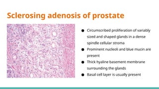 Prostate Pattern D MORPHOLOGICAL PATTERNS OF PROSTATE TUMORS.pptx