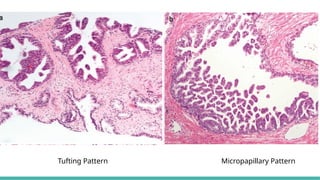 Pattern 3 Prostate MORPHOLOGICAL PATTERNS OF PROSTATE TUMORS.pptx