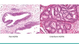 Protate Pattern 4 MORPHOLOGICAL PATTERNS OF PROSTATE TUMORS.pptx