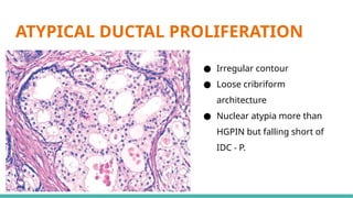 Prostate Pattern D MORPHOLOGICAL PATTERNS OF PROSTATE TUMORS.pptx