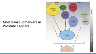 Prostate Pattern D MORPHOLOGICAL PATTERNS OF PROSTATE TUMORS.pptx