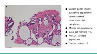 Pattern 3 Prostate MORPHOLOGICAL PATTERNS OF PROSTATE TUMORS.pptx