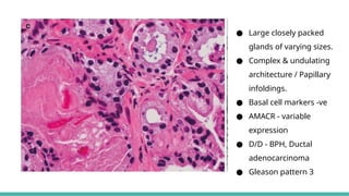 Prostate Pattern D MORPHOLOGICAL PATTERNS OF PROSTATE TUMORS.pptx