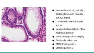 MORPHOLOGICAL PATTERNS OF PROSTATE TUMORS.pptx