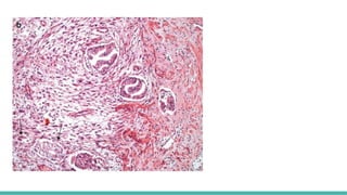Prostate Pattern D MORPHOLOGICAL PATTERNS OF PROSTATE TUMORS.pptx