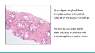 Prostate Pattern D MORPHOLOGICAL PATTERNS OF PROSTATE TUMORS.pptx