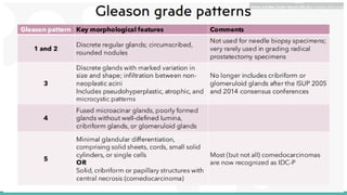 Prostate Pattern D MORPHOLOGICAL PATTERNS OF PROSTATE TUMORS.pptx
